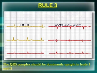 RULE 3
The QRS complex should be dominantly upright in leads I
and II
 