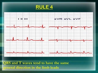 RULE 4
QRS and T waves tend to have the same
general direction in the limb leads
 
