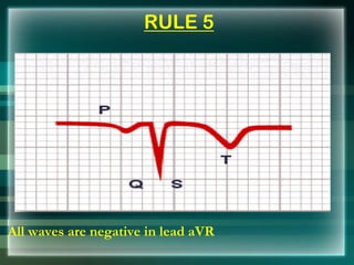 RULE 5
All waves are negative in lead aVR
 