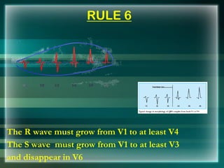RULE 6
The R wave must grow from V1 to at least V4
The S wave must grow from V1 to at least V3
and disappear in V6
 