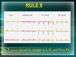 RULE 8
The P waves should be upright in I, II, and V2 to V6
 
