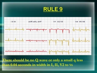 RULE 9
There should be no Q wave or only a small q less
than 0.04 seconds in width in I, II, V2 to V6
 