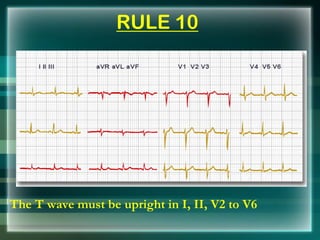 RULE 10
The T wave must be upright in I, II, V2 to V6
 