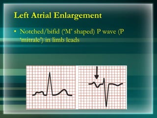 • Notched/bifid (‘M’ shaped) P wave (P
‘mitrale’) in limb leads
Left Atrial Enlargement
 