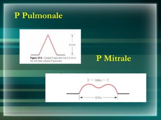 P Pulmonale
P Mitrale
 