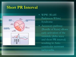Short PR Interval
• WPW (Wolff-
Parkinson-White)
Syndrome
• Accessory pathway
(Bundle of Kent) allows
early activation of the
ventricle (delta wave
and short PR interval)
resulting in Atrio
ventricular reentrant
tachycardia.
 