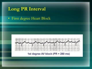 Long PR Interval
• First degree Heart Block
 