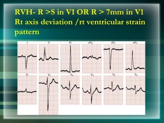 RVH- R >S in V1 OR R > 7mm in V1
Rt axis deviation /rt ventricular strain
pattern
 