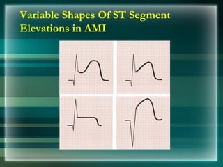 Variable Shapes Of ST Segment
Elevations in AMI
 