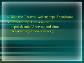 » Biphasic T waves- wellens type 2 syndrome
» Camel hump T waves- severe
hypokalaemia(U waves) and sinus
tachycardia (hidden p waves )
 