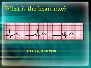 What is the heart rate?
(300 / 6) = 50 bpm
 