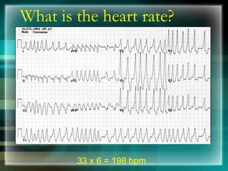 What is the heart rate?
33 x 6 = 198 bpm
 