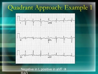 Quadrant Approach: Example 1
Negative in I, positive in aVF →
 