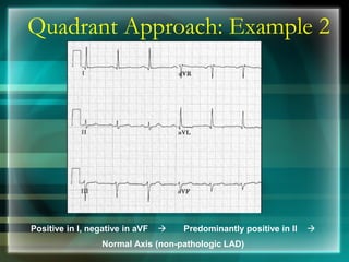 Quadrant Approach: Example 2
Positive in I, negative in aVF → Predominantly positive in II →
Normal Axis (non-pathologic LAD)
 