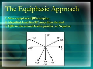 The Equiphasic Approach
1. Most equiphasic QRS complex.
2. Identified Lead lies 90° away from the lead
3. QRS in this second lead is positive or Negative
 