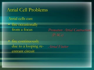 Atrial Cell Problems
Atrial cells can:
• fire occasionally
from a focus
• fire continuously
due to a looping re-
entrant circuit
Premature Atrial Contractions
(PACs)
Atrial Flutter
 