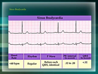Sinus Bradycardia
 