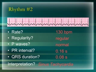 Rhythm #2
130 bpm• Rate?
• Regularity? regular
normal
0.08 s
• P waves?
• PR interval? 0.16 s
• QRS duration?
Interpretation? Sinus Tachycardia
 