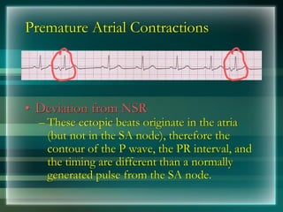 Premature Atrial Contractions
• Deviation from NSR
– These ectopic beats originate in the atria
(but not in the SA node), therefore the
contour of the P wave, the PR interval, and
the timing are different than a normally
generated pulse from the SA node.
 