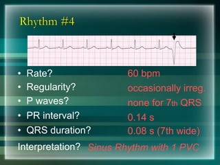 Rhythm #4
60 bpm• Rate?
• Regularity? occasionally irreg.
none for 7th QRS
0.08 s (7th wide)
• P waves?
• PR interval? 0.14 s
• QRS duration?
Interpretation? Sinus Rhythm with 1 PVC
 