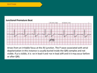 RHYTHM
Junctional Premature Beat
Arises from an irritable focus at the AV junction. The P wave associated with atrial
depolarization in this instance is usually buried inside the QRS complex and not
visible. If p is visible, it is -ve in lead II and +ve in lead aVR and it it may occur before
or after QRS.
 