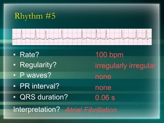 Rhythm #5
100 bpm• Rate?
• Regularity? irregularly irregular
none
0.06 s
• P waves?
• PR interval? none
• QRS duration?
Interpretation? Atrial Fibrillation
 