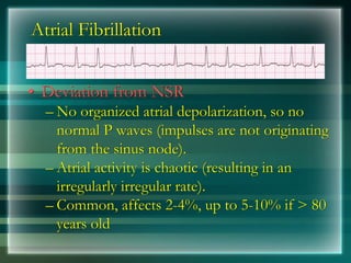 Atrial Fibrillation
• Deviation from NSR
– No organized atrial depolarization, so no
normal P waves (impulses are not originating
from the sinus node).
– Atrial activity is chaotic (resulting in an
irregularly irregular rate).
– Common, affects 2-4%, up to 5-10% if > 80
years old
 