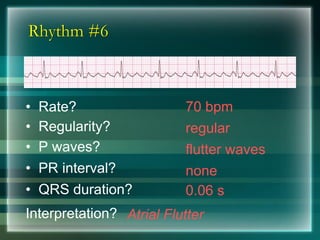 Rhythm #6
70 bpm• Rate?
• Regularity? regular
flutter waves
0.06 s
• P waves?
• PR interval? none
• QRS duration?
Interpretation? Atrial Flutter
 