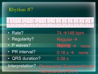 Rhythm #7
74 →148 bpm• Rate?
• Regularity? Regular →
regularNormal → none
0.08 s
• P waves?
• PR interval? 0.16 s → none
• QRS duration?
Interpretation? Paroxysmal Supraventricular
Tachycardia (PSVT)
 