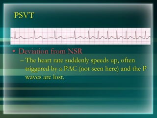 PSVT
• Deviation from NSR
– The heart rate suddenly speeds up, often
triggered by a PAC (not seen here) and the P
waves are lost.
 