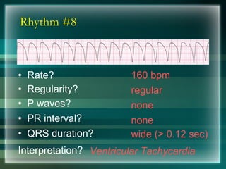 Rhythm #8
160 bpm• Rate?
• Regularity? regular
none
wide (> 0.12 sec)
• P waves?
• PR interval? none
• QRS duration?
Interpretation? Ventricular Tachycardia
 