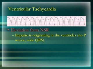 Ventricular Tachycardia
• Deviation from NSR
– Impulse is originating in the ventricles (no P
waves, wide QRS).
 