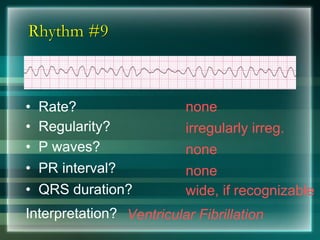 Rhythm #9
none• Rate?
• Regularity? irregularly irreg.
none
wide, if recognizable
• P waves?
• PR interval? none
• QRS duration?
Interpretation? Ventricular Fibrillation
 