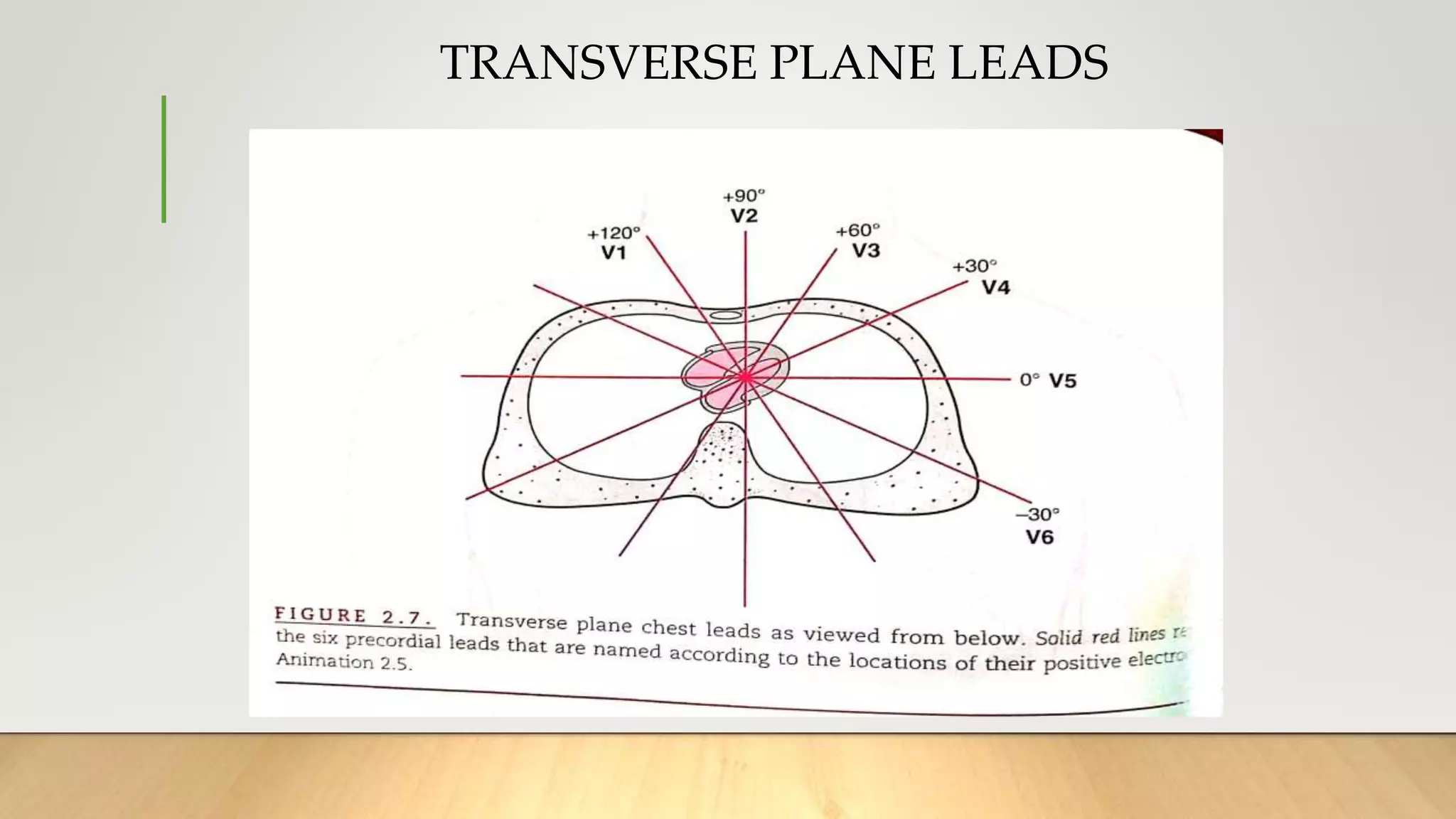 TRANSVERSE PLANE LEADS
 