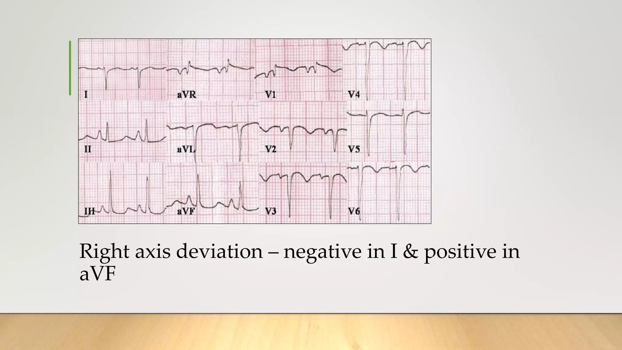 Right axis deviation – negative in I & positive in
aVF
 