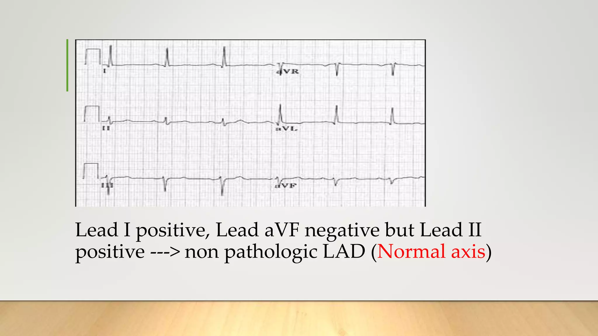 Lead I positive, Lead aVF negative but Lead II
positive ---> non pathologic LAD (Normal axis)
 