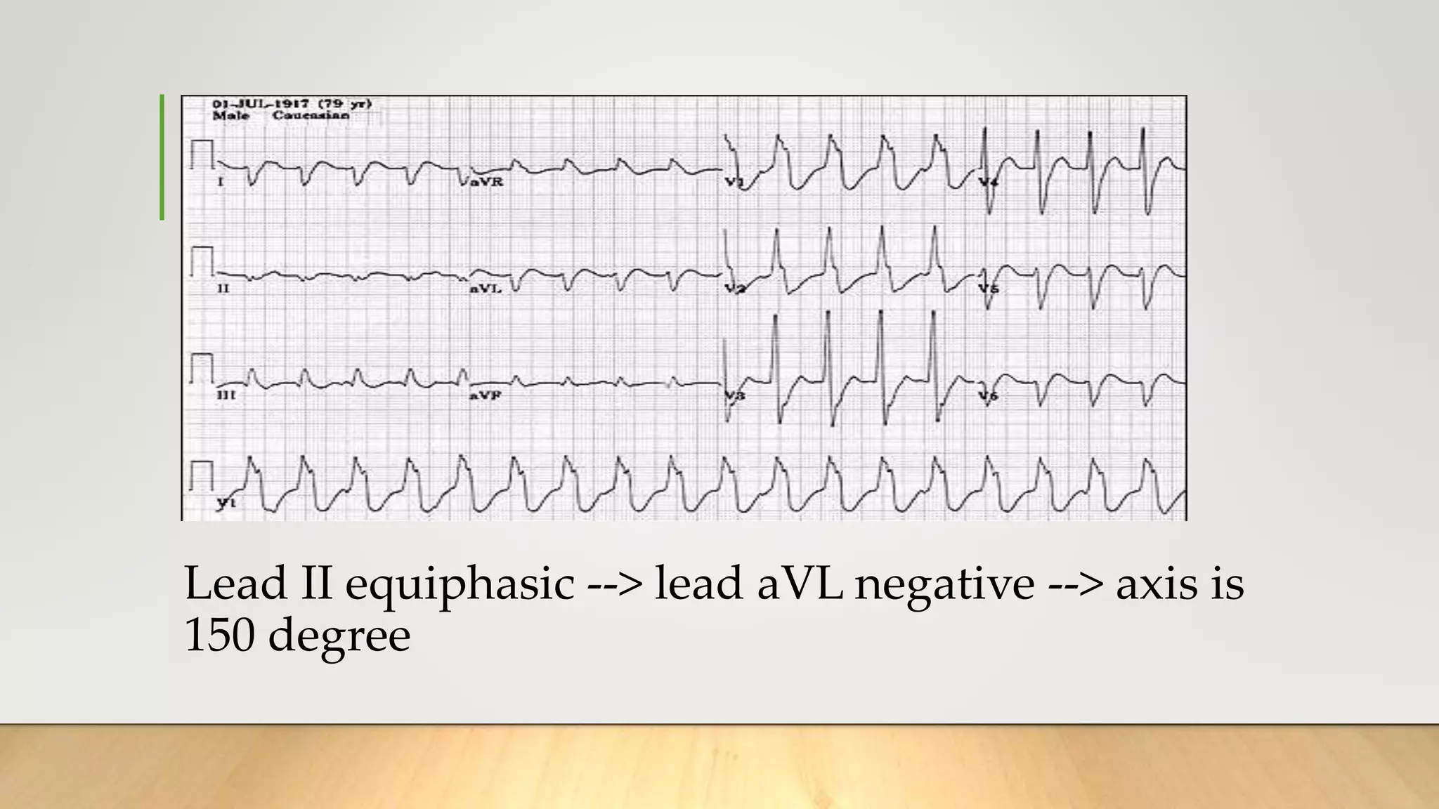 Lead II equiphasic --> lead aVL negative --> axis is
150 degree
• kjkg
 