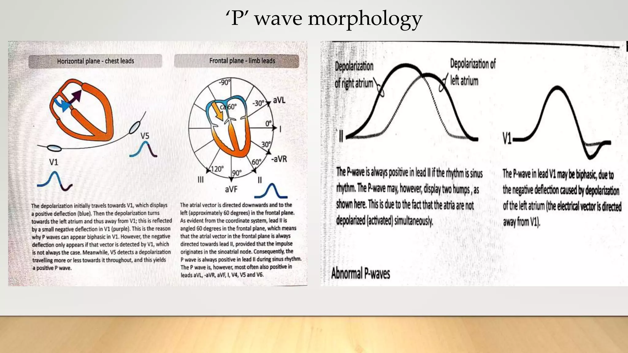 ‘P’ wave morphology
 