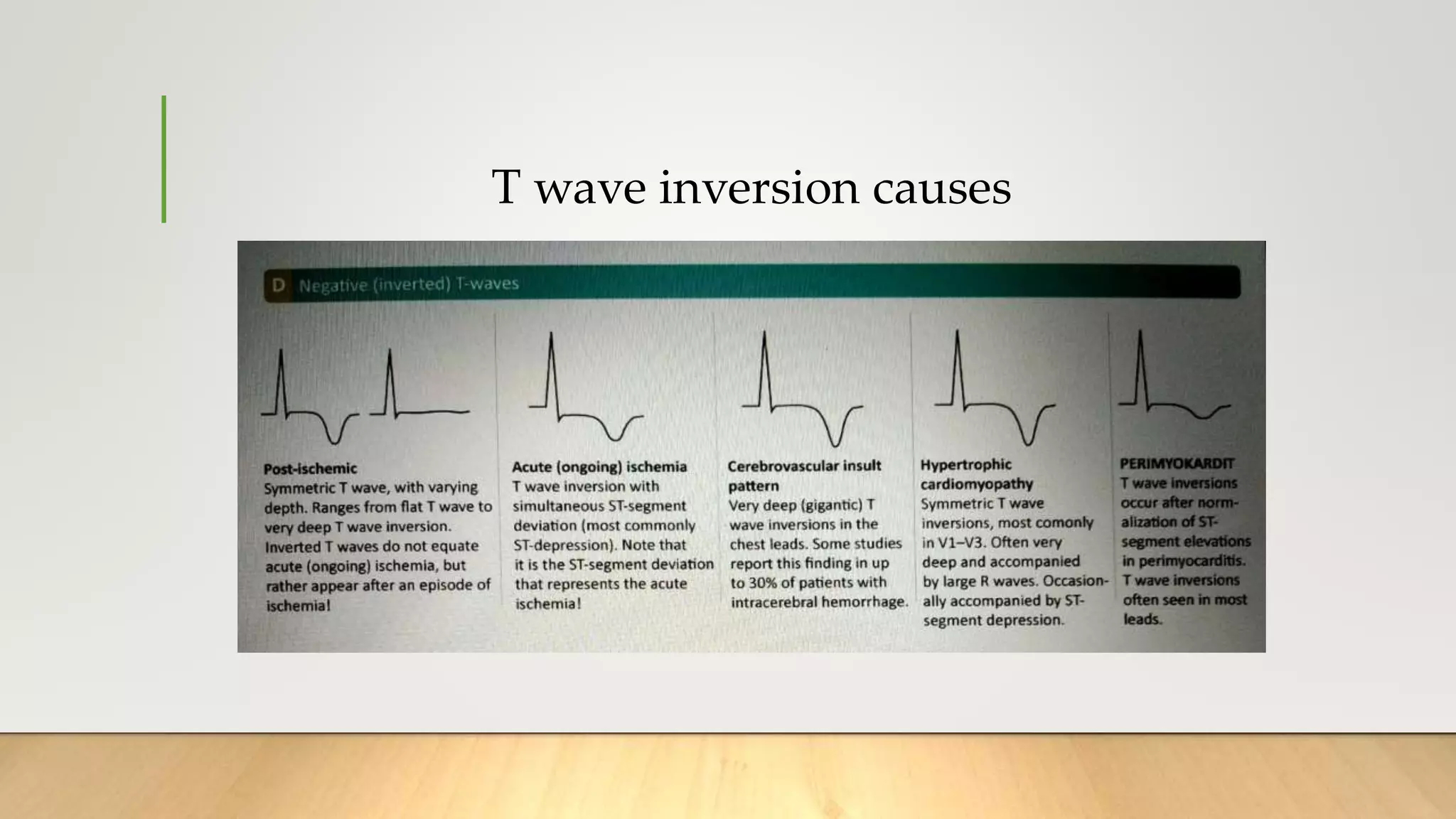 T wave inversion causes
 
