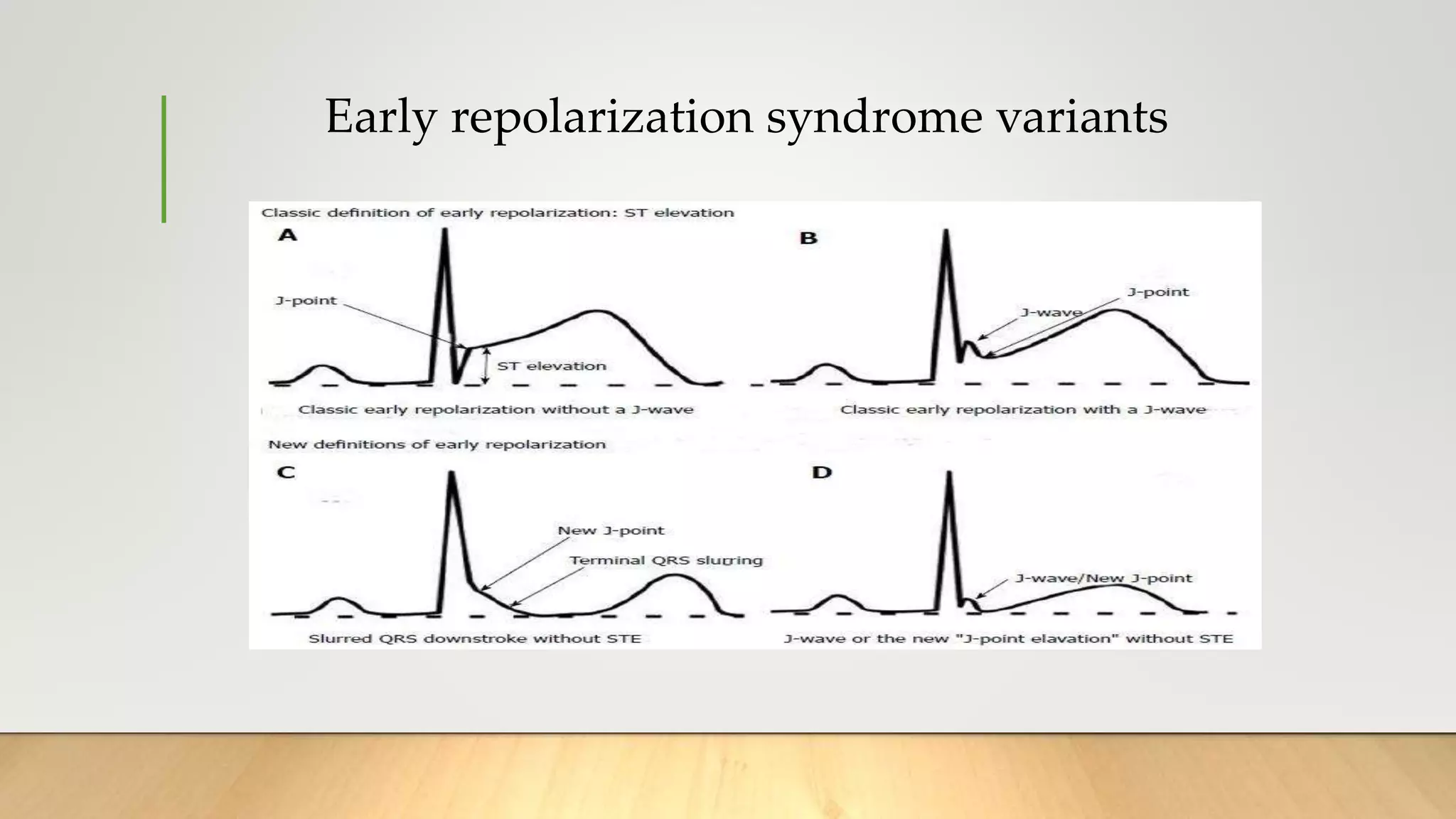 Early repolarization syndrome variants
 