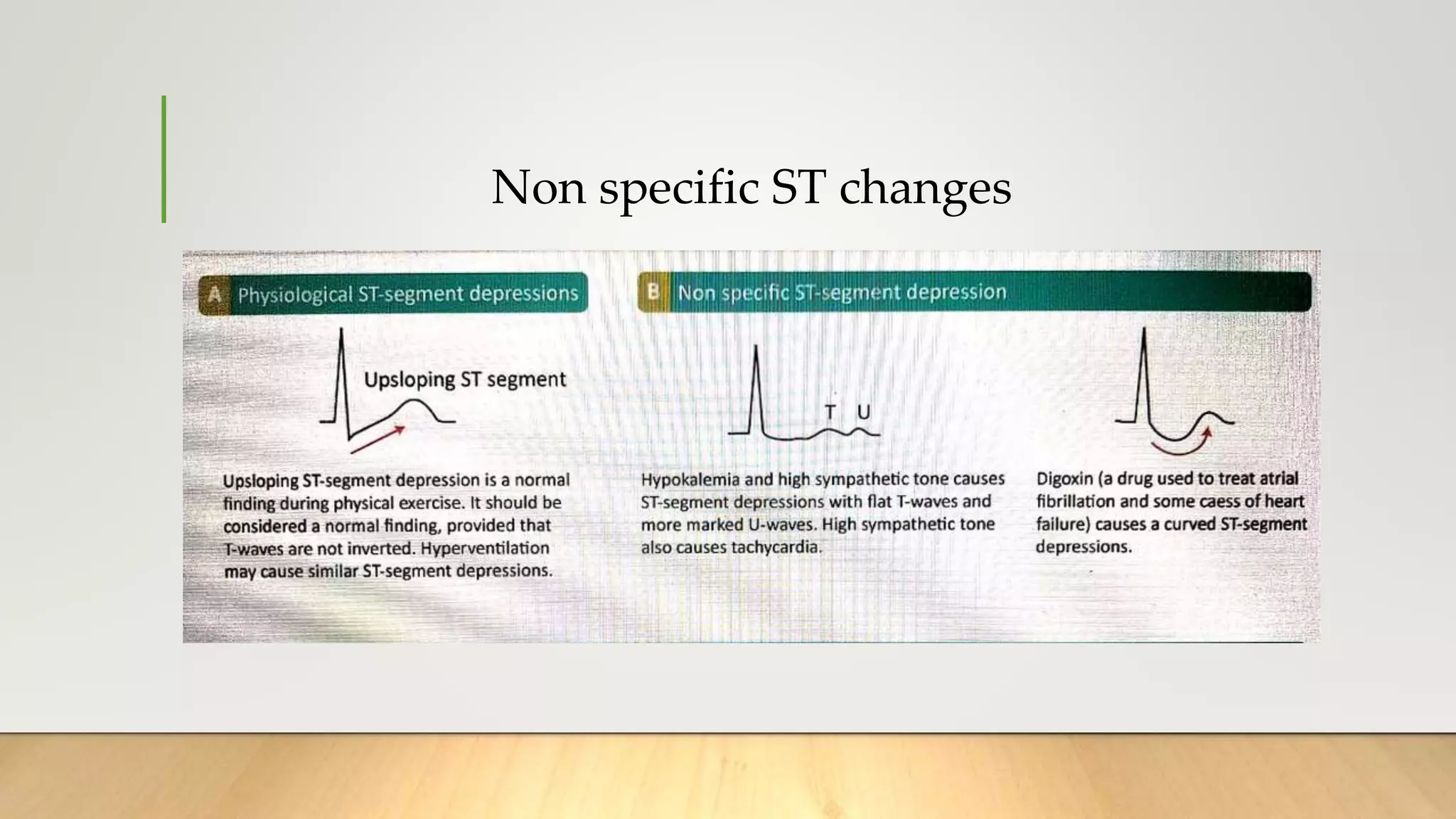 Non specific ST changes
 