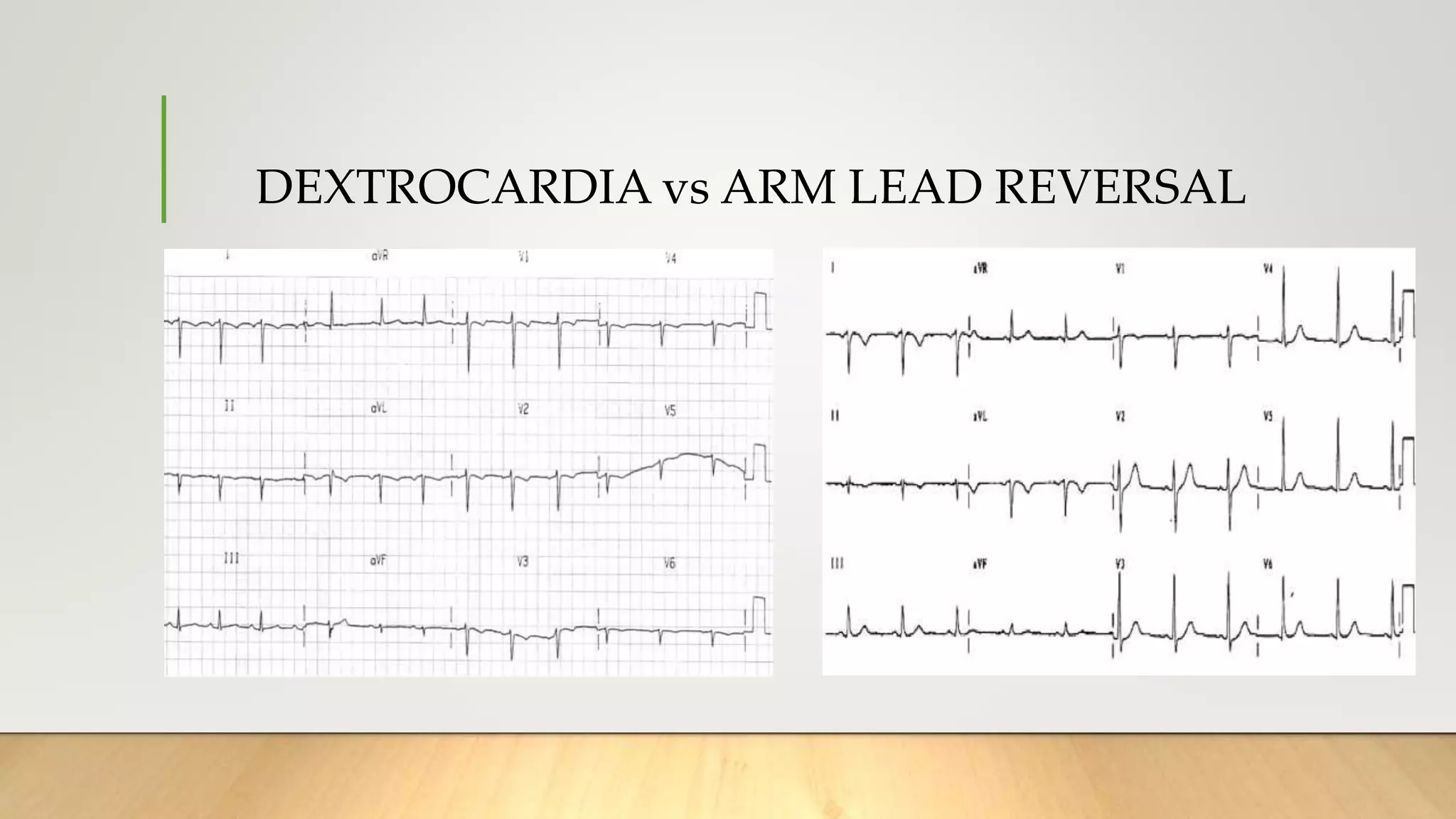 DEXTROCARDIA vs ARM LEAD REVERSAL
 
