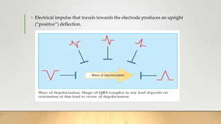• Electrical impulse that travels towards the electrode produces an upright
(“positive”) deflection.
 