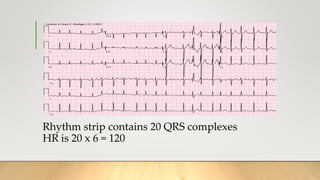 Rhythm strip contains 20 QRS complexes
HR is 20 x 6 = 120
 