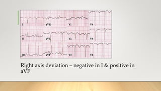 Right axis deviation – negative in I & positive in
aVF
 