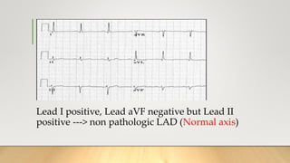 Lead I positive, Lead aVF negative but Lead II
positive ---> non pathologic LAD (Normal axis)
 