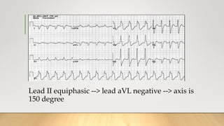 Lead II equiphasic --> lead aVL negative --> axis is
150 degree
• kjkg
 