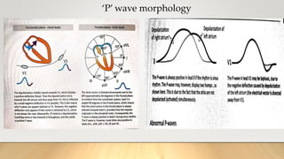 ‘P’ wave morphology
 