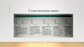 T wave inversion causes
 