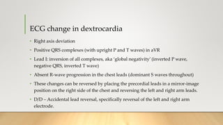 ECG change in dextrocardia
• Right axis deviation
• Positive QRS complexes (with upright P and T waves) in aVR
• Lead I: inversion of all complexes, aka ‘global negativity’ (inverted P wave,
negative QRS, inverted T wave)
• Absent R-wave progression in the chest leads (dominant S waves throughout)
• These changes can be reversed by placing the precordial leads in a mirror-image
position on the right side of the chest and reversing the left and right arm leads.
• D/D – Accidental lead reversal, specifically reversal of the left and right arm
electrode.
 